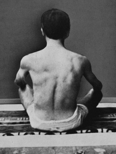 24-year-old male patient with scoliosis