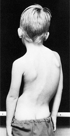 5-year-old boy, scoliosis resulting from polio