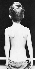 After 8 weeks of Schroth scoliosis exercise therapy