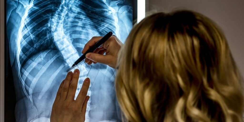 doctor marketing xray of vertebrae scoliosis farther away