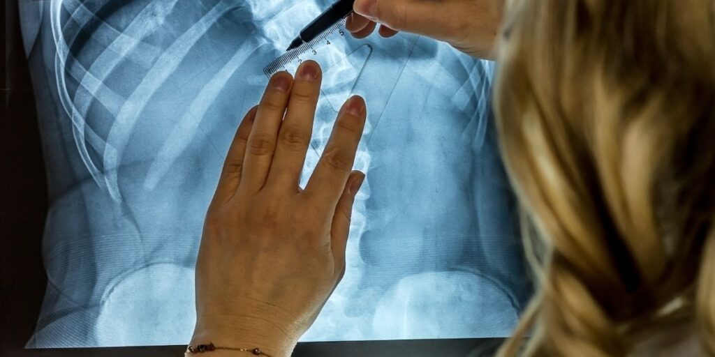 doctor marking xray of vertebrae scoliosis